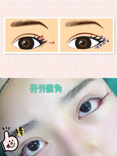 开外眼角一定会回缩吗?