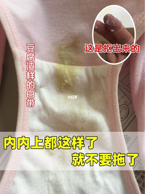 居然用手扣出了豆腐渣7515_妇科_凝胶_大姨妈_止痒_清洁_私处