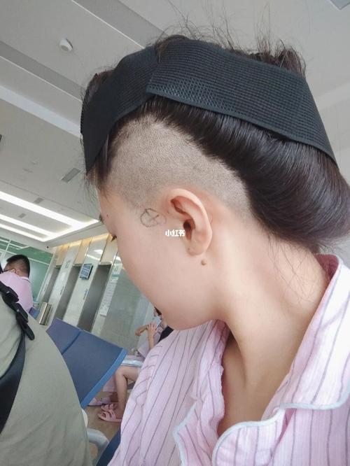 耳前瘘管手术全记录_医保_疫情_消肿_核酸检测_护士_耳前瘘管手术