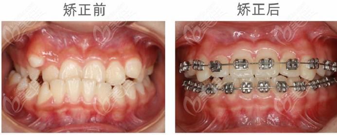 牙齿矫正前后对比