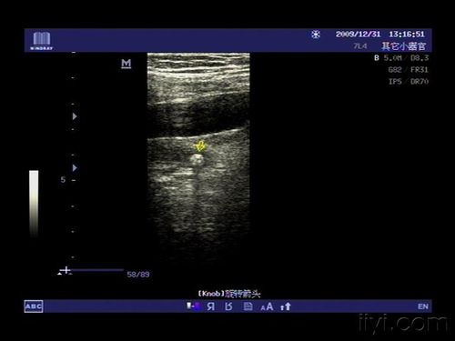 再看一例左侧输尿管中段的结石,位于髂血管分叉稍下方