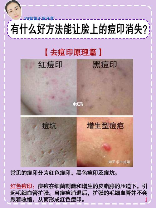 如何消除脸上不同颜色的痘印71_痘印_祛痘印_去痘印