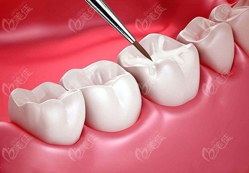 哈尔滨美中口腔堵牙多少钱牙齿龋齿找常亮医生做复合树脂补牙怎么样