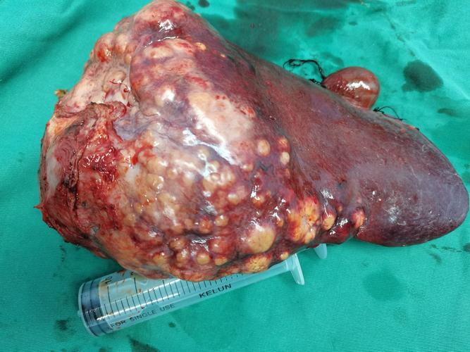 右肝巨大肿瘤切除(极限肝切除)纪实