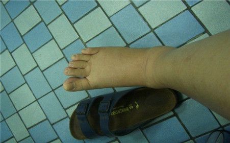 下肢淋巴水肿的治疗原则