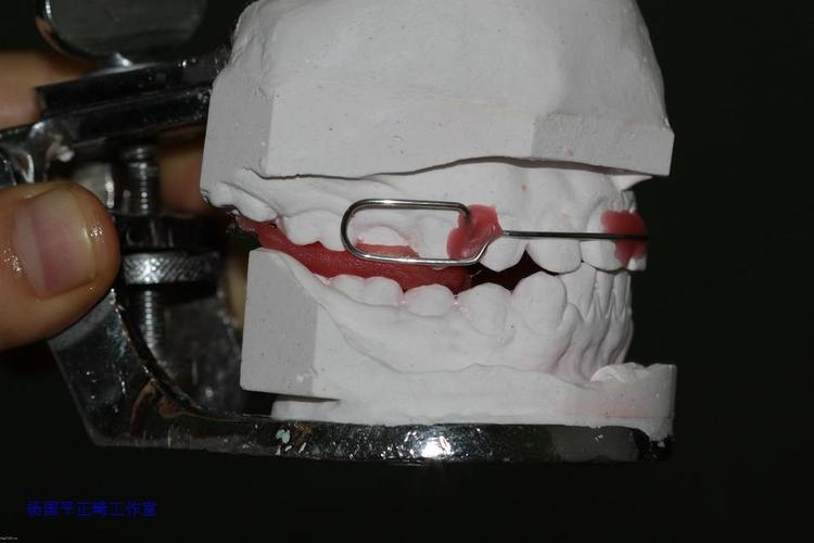 bionator矫治器的制作