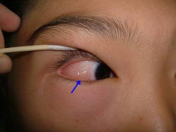 眼睛过敏狂揉竟使眼白水肿如荔枝!