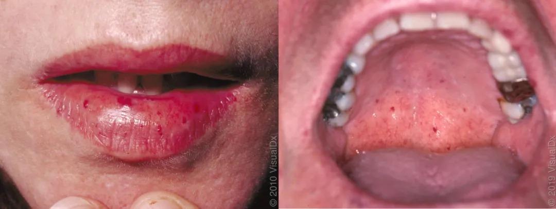 宝宝上颚有红点以及频繁流鼻血