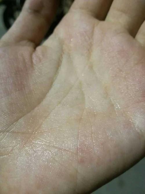 手常年出汗脱皮 一到夏天就长水泡 出汗特别严重 这是