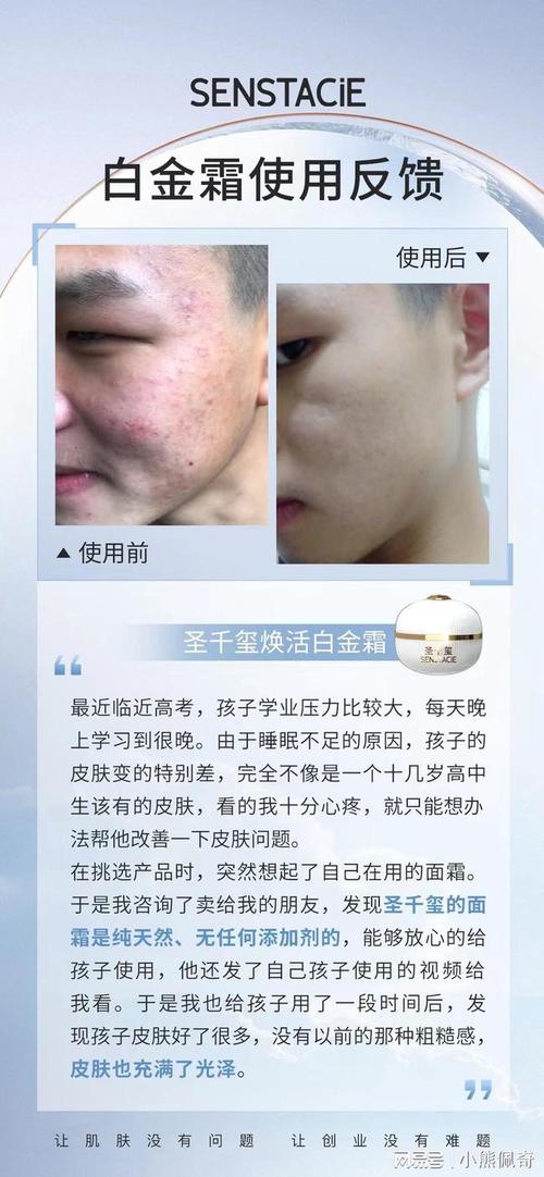 圣千玺青春痘修复案例