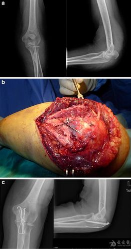 转帖钢板或张力带治疗尺骨鹰嘴骨折