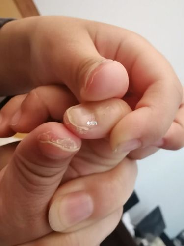 甲周疣(刺瘊)好了,方法分享给大家_碘伏_抖音_清凉油