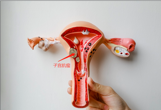 发现子宫肌瘤几年,我选择了这种方式治疗
