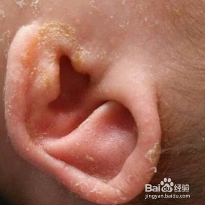 婴幼儿耳朵流出液体怎么办