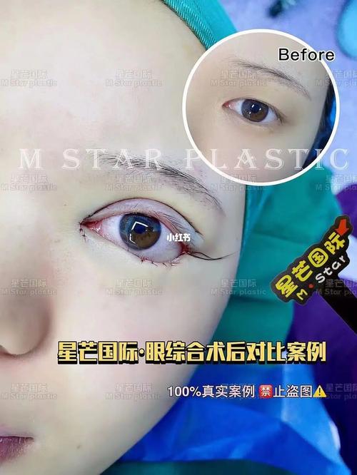 69眼综合术后对比案例90 术后形态自然_美妆_医美