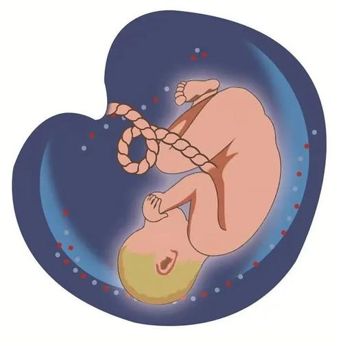 39周脐带扭转胎停,牢记这三招让脐带扭转靠边站