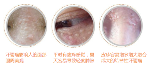 汗管瘤_汗管瘤的治疗方法