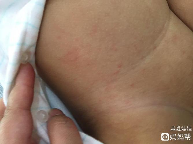 九个月了,带宝宝打防疫针,一针麻风疫苗