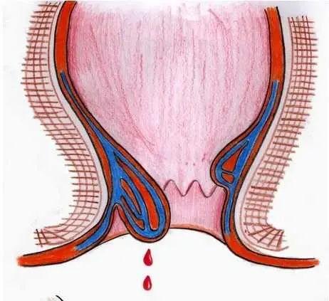 在初期,痔核脱出一般可自行回纳,到痔疮晚期,会出现痔核脱出无法回纳