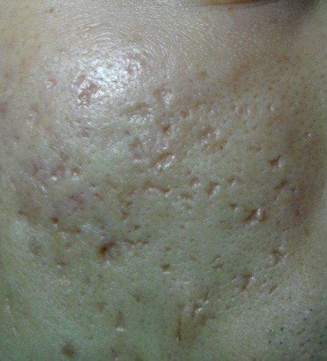 怎样祛除痘印痘疤