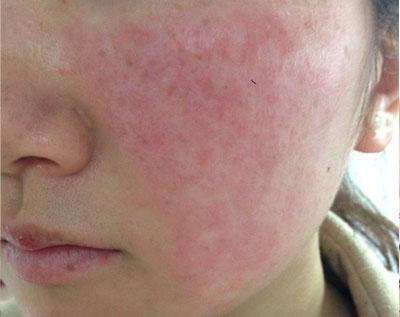 您可能患上了过敏性皮肤疾病!