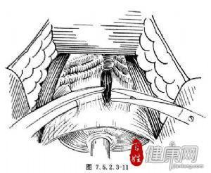 88.切断膀胱颈
