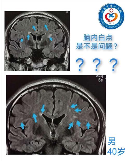 磁共振上脑内白点怎么看?