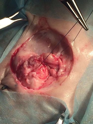 一例尿道造口复发病例