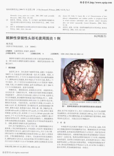 是一种少见的头部慢性化脓性皮肤病,现将笔者诊治的1例报告如下