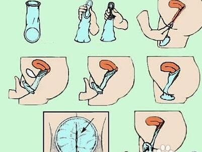 女用避孕套使用完之后,抓住大环拧几圈拽出来就行.