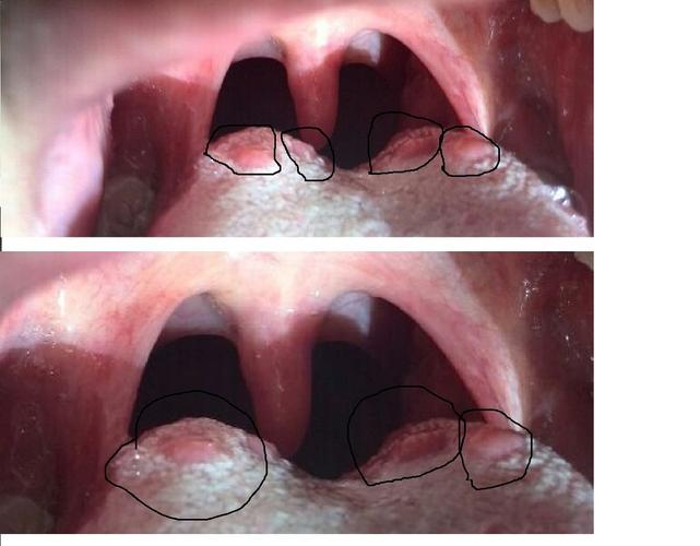舌头里有红色斑点是怎么回事?