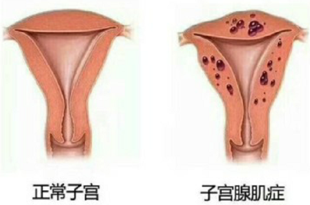 什么是子宫腺肌病(症)?