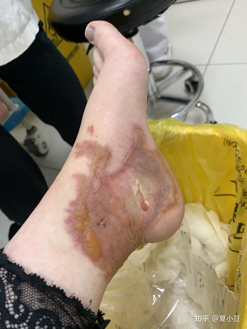 浅二度深二度烫伤过程