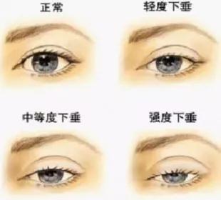 痿症老专家刘泉鹏在疫情期间讲解:什么是眼肌型重症肌无力呢?