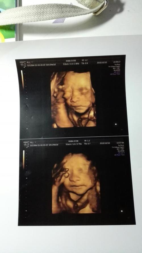 四维彩超结果取消只看楼主