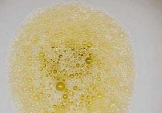 尿液中有"泡沫",是肾脏出了问题吗?可能看完后你就明白了!