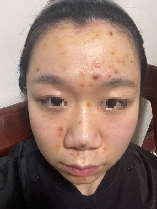 成年人得水痘全过程