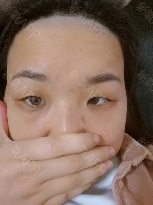 脱完发际线后,即刻,往上脱的有一到两厘米.比正常额