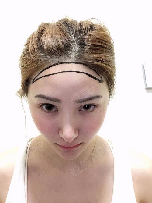 这两年真的不知道自己经历了什么,发际线后移的有点"秃然,自己也想过