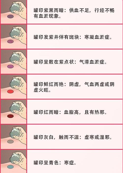 根据中医角度来看,拔罐后印记颜色的深浅,并不能说明身体的好坏,但