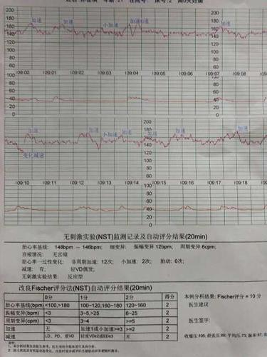 今天预产期过的第五天,胎心监测十分