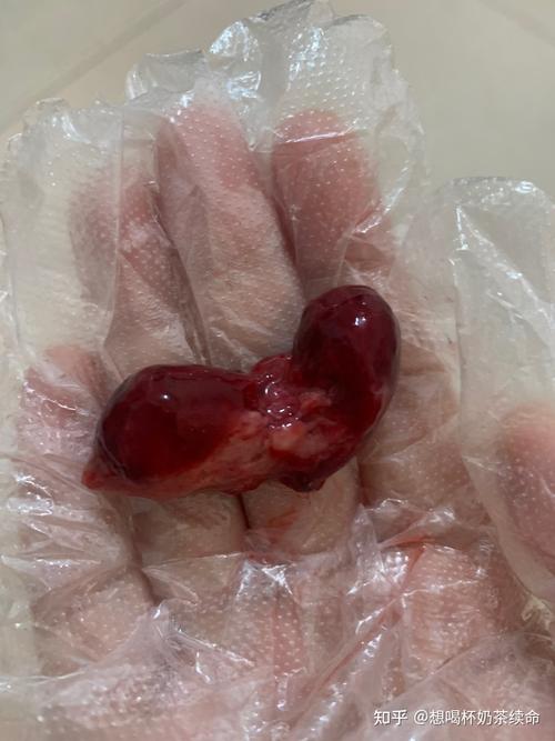 记录药流全过程,历经1个月孕囊残留未完,后续总结一些事项.