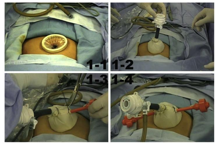 自制单孔穿刺器,费时费力不好用