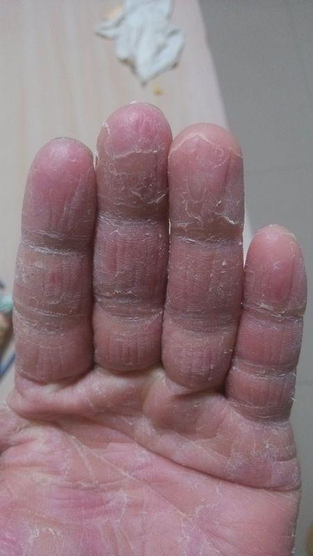 水泡性手癣怎么治?
