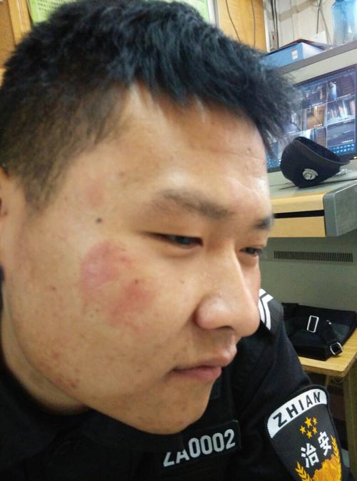 这脸是长什么啦? 什么癣