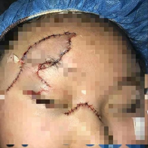 揪心!钢板险"削掉"女孩面部皮肤 手术3小时缝合伤口