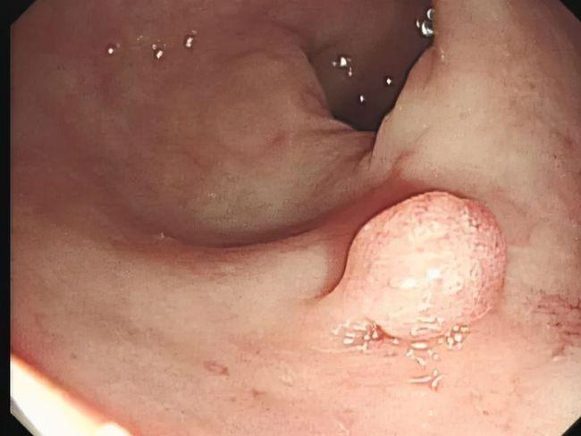 网易首页>网易号>正文申请入驻> 简单说就是肠壁上长出的小肉疙瘩,大
