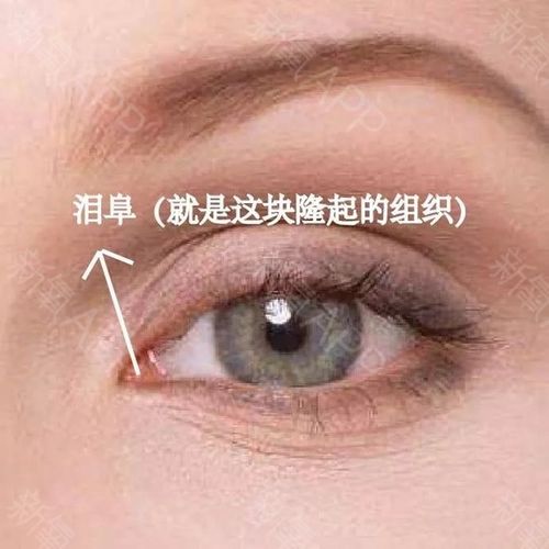 这个内眦赘皮其实是依据泪阜的暴露程度来判断的
