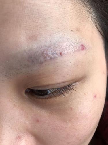 李修肤--河南美女皮秒洗眉失败,来到本院!