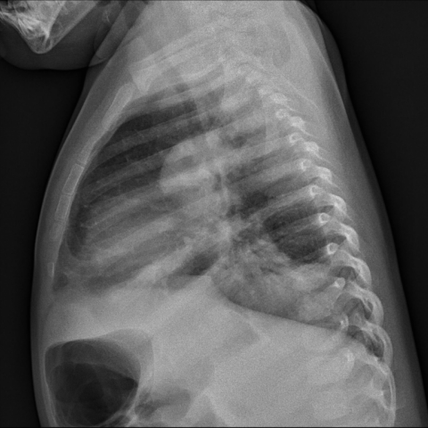 侧位胸片显示左下叶局部肺不张及实变,肺门内有气体